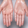 How to Manage Excessive Sweating: Understanding Hyperhidrosis