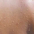 Body scans for sweat awareness: How to prevent and control excessive sweating